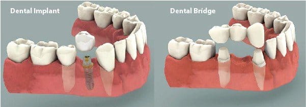 Dental Implants