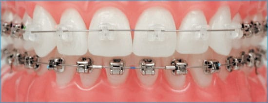 Adult Orthodontics