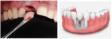 Dental Implants and Bone Loss: