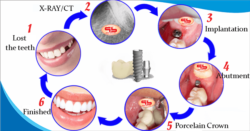 Dental Implants