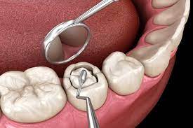 Traditional Fillings