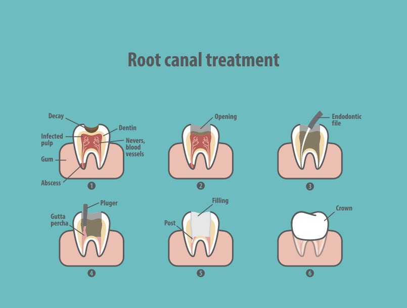 Root Canal Near Me