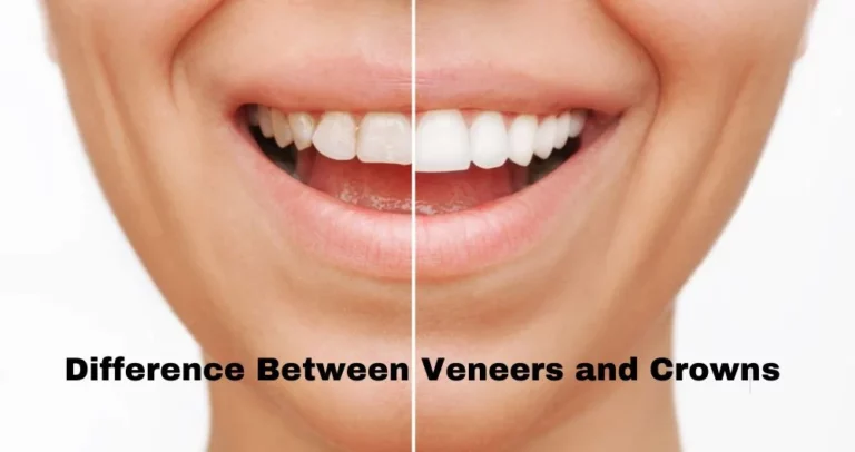 What is the Difference Between Veneers and Crowns?