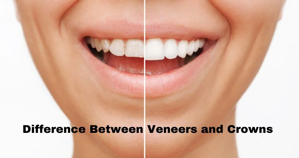 Difference Between Veneers and Crowns