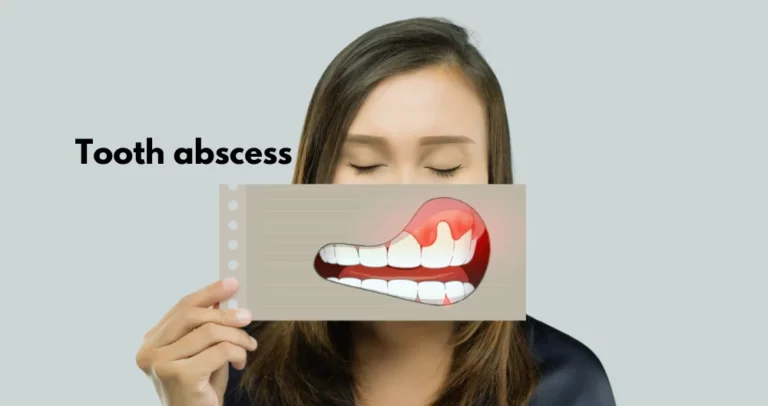 Tooth Abscess – Symptoms, Causes & Treatment