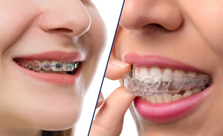 Invisalign vs. Braces: A Dentist Explains the Clear Choice for Straightening Your Smile