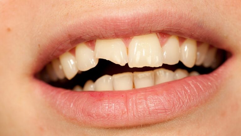 Chipped Tooth? Here’s What Your Dentist Wants You to Do (and What NOT to Do)