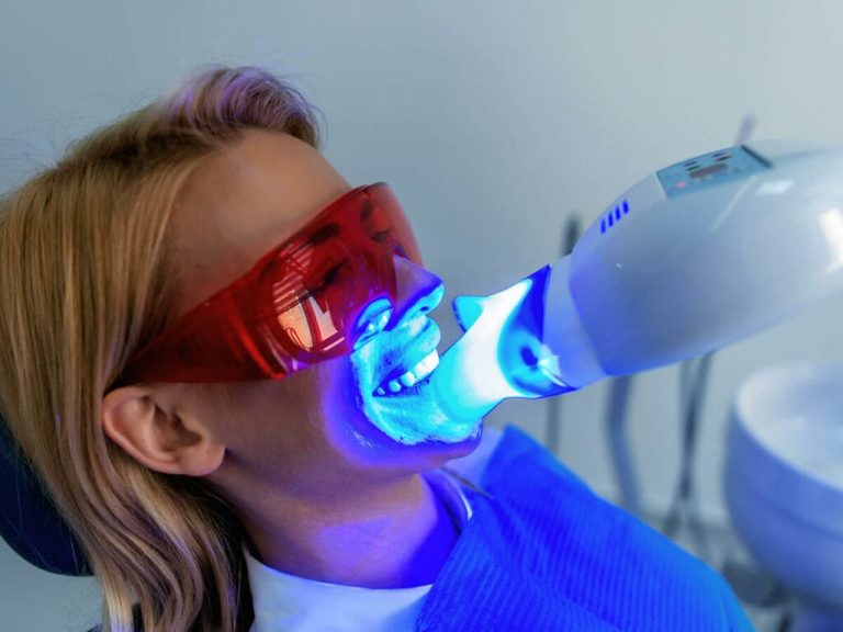Professional Teeth Whitening vs. Over-the-Counter Products: Pros and Cons
