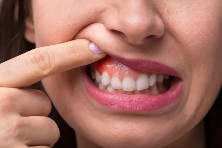 Gum Disease: Don’t Ignore the Warning Signs! A Dentist Explains Prevention and Treatment
