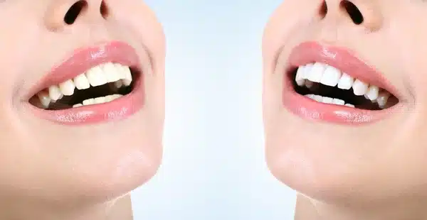 Natural Teeth Whitening Remedies: Do They Really Work?