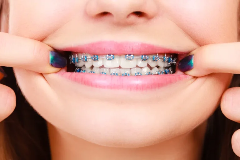Braces Care 101: Maintaining Oral Hygiene with Orthodontic Appliances