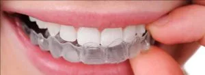 Retainers: Why They’re Essential After Orthodontic Treatment