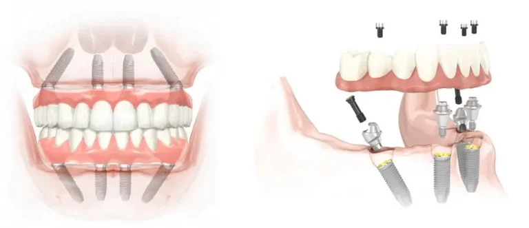  Dental Implants and Bone Loss: Understanding the Connection