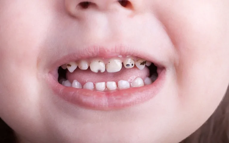 Baby Bottle Tooth Decay: Prevention Tips for Infants