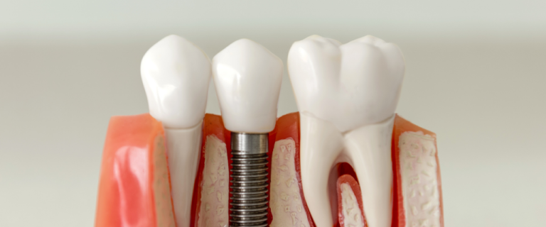 The Complete Guide to Dental Implants: Are They Right for You?