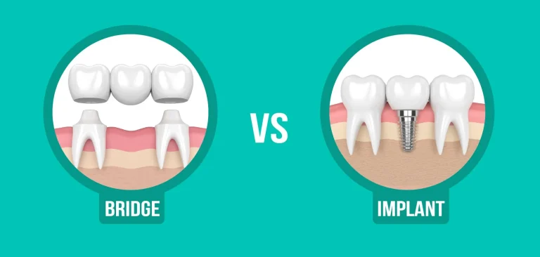 Dental Implants vs. Bridges: Which is the Best Option for Replacing Missing Teeth?