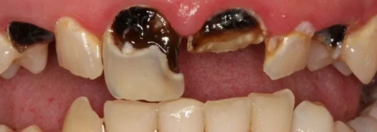 The Ultimate Guide to Preventing Tooth Decay at Every Age