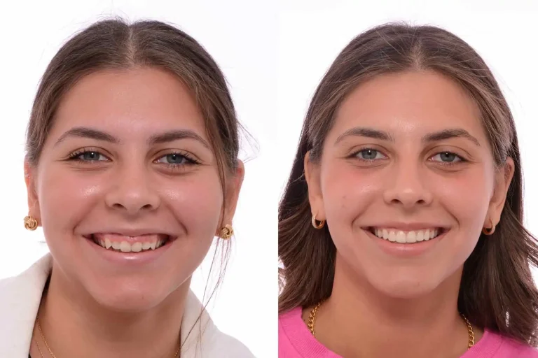 Correcting Gummy Smiles: Treatment Options and Benefits
